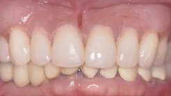 denture restoration at Corner Stone Dental