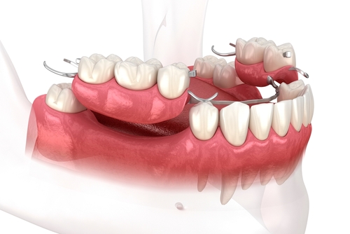 partial dentures