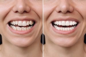 before and after porcelain veneers