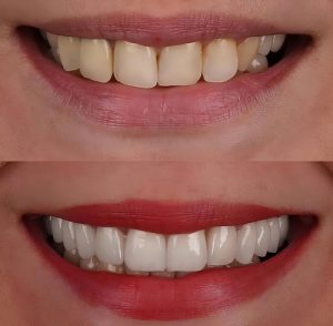 veneers